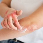 choosing an ointment for eczema