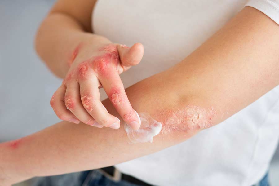 choosing an ointment for eczema