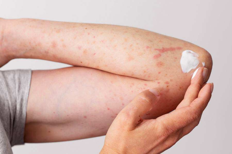 why ointments for eczema are used